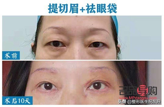 提眉與雙眼皮：哪個效果更佳？