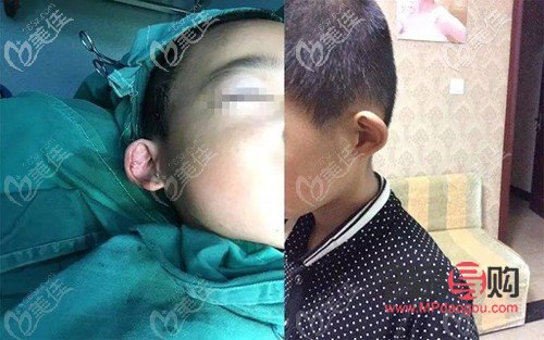 對眼矯正手術多少錢22歲(對眼矯正手術價格)