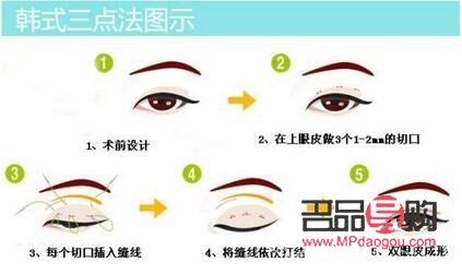 雙眼皮三點定位是什么意思(雙眼皮三點定位好嗎)