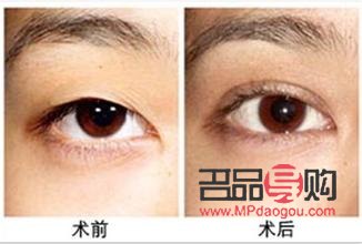 <h3>整容眼睛需要多少錢一次？了解眼部整形費用及考量因素</h3>
