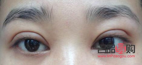 雙眼皮手術(shù)風(fēng)險(xiǎn)大不大(雙眼皮手術(shù)風(fēng)險(xiǎn)大不大知乎)