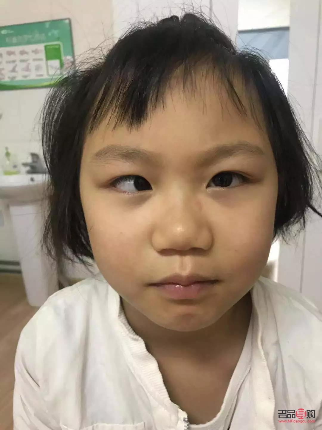 斗雞眼矯正手術康復時間詳解