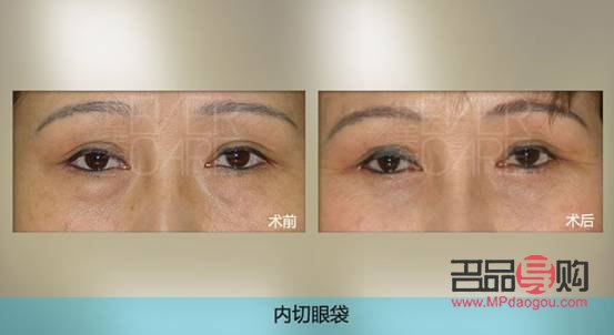 鄭州割眼袋手術費一般是多少(鄭州割眼袋手術費一般是多少錢)