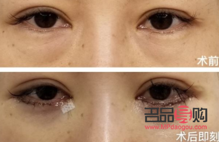 鄭州割眼袋手術費一般是多少(鄭州割眼袋手術費一般是多少錢)