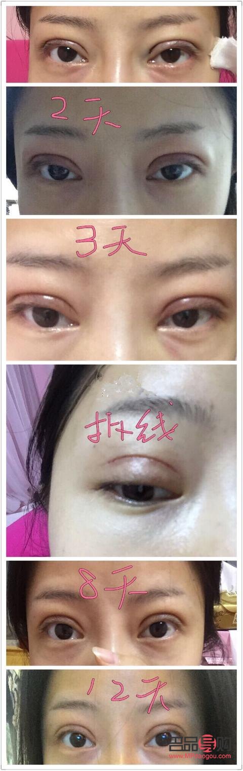雙眼皮埋線恢復期與辣食攝入指南