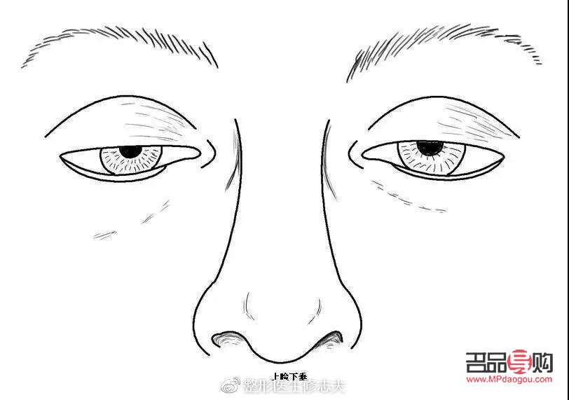 眼睛肌無力：探尋治愈之路