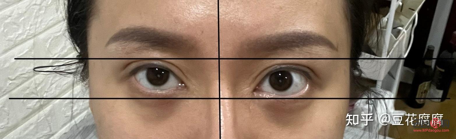 眼睛高低不對稱怎么辦？專業解答與實用建議