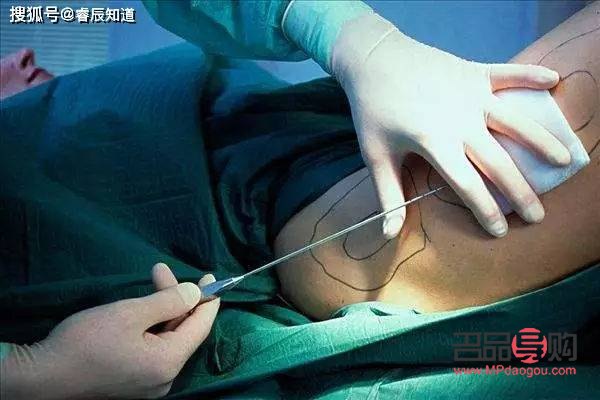 腫眼泡抽脂后皮膚會松弛嗎？