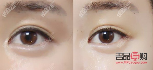 <h3>眼窩凹陷填充脂肪價(jià)格解析</h3>