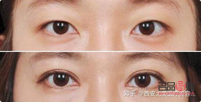 雙眼皮定點是怎么弄的(雙眼皮定點是什么)