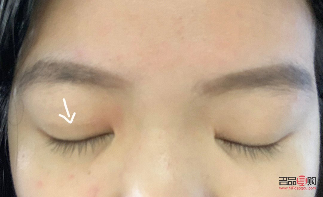 腫眼泡按摩能否有效消除？
