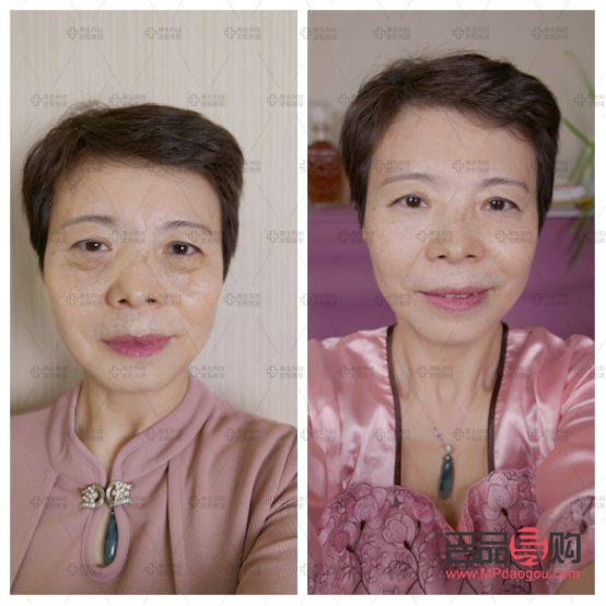 豹紋媽媽去掉眼袋價(jià)格探究