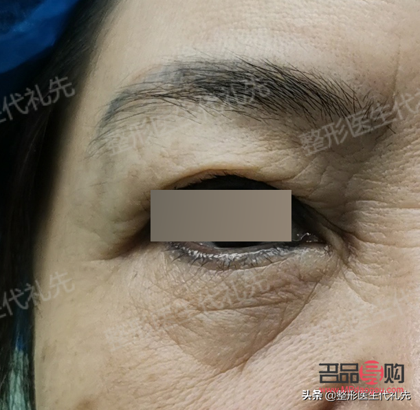 眼袋手術(shù)后的疤痕問(wèn)題：能否自動(dòng)消掉？