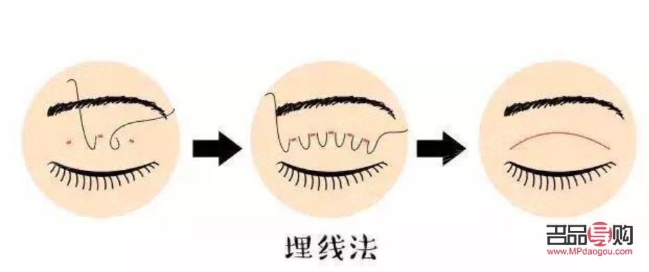 定點埋線雙眼皮能維持幾年(定點埋線雙眼皮能維持幾年呢)