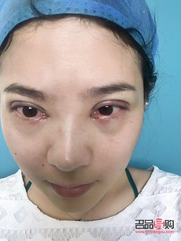 定點埋線雙眼皮能維持幾年(定點埋線雙眼皮能維持幾年呢)