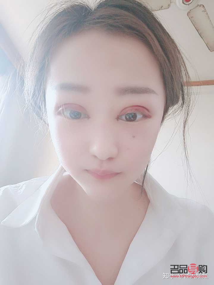 割雙眼皮多久恢復自然(割雙眼皮多久恢復自然呢)
