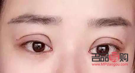開眼角手術一般需要多久恢復自然(開眼角手術一般需要多久恢復自然圖片)