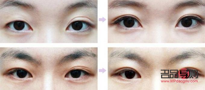 50歲還能做雙眼皮修復手術嗎(50歲還能做雙眼皮修復手術嗎視頻)