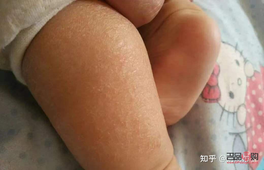 寶寶身體干燥怎么護理(寶寶身體干燥怎么護理最好)
