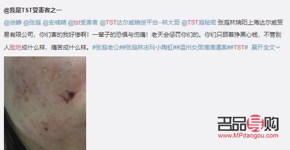 身體爛掉如何有效護理？