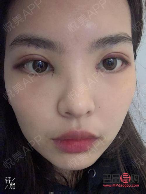 雙眼皮手術的眼綜合包括哪些項目(雙眼皮眼綜合手術包括什么項目)