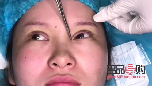 免麻雙眼皮是怎么操作的(免麻雙眼皮是什么技術)
