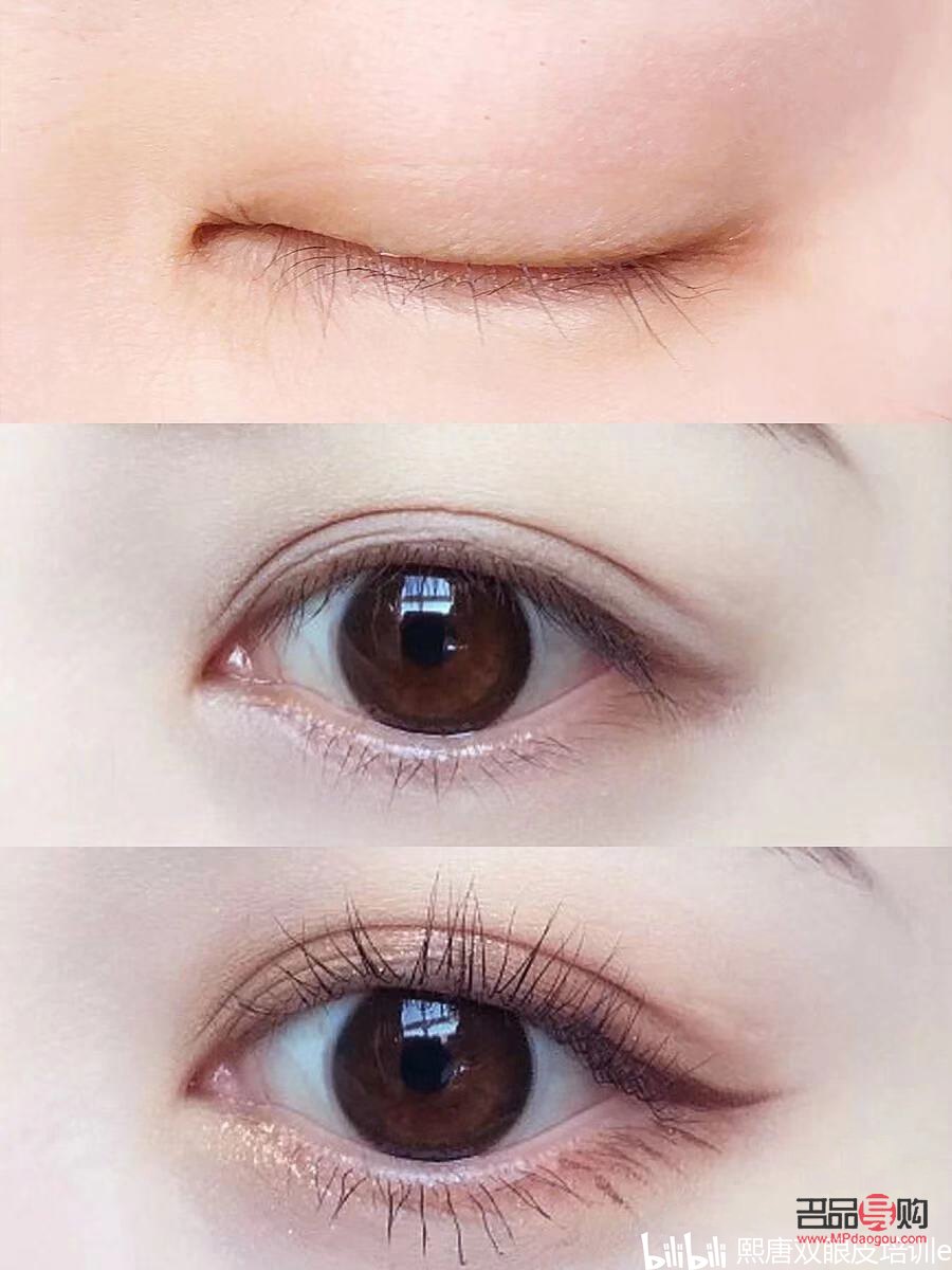 免麻雙眼皮是怎么操作的(免麻雙眼皮是什么技術)