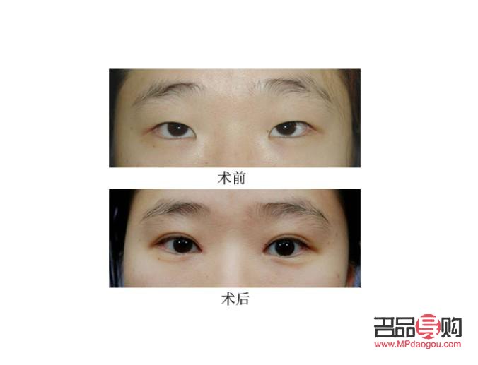 雙眼皮手術(shù)價(jià)格探究：美麗需要多少成本？
