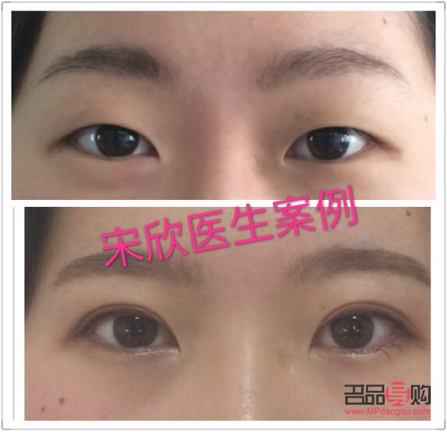 眼角下垂手術視頻(眼角下垂手術視頻教程)
