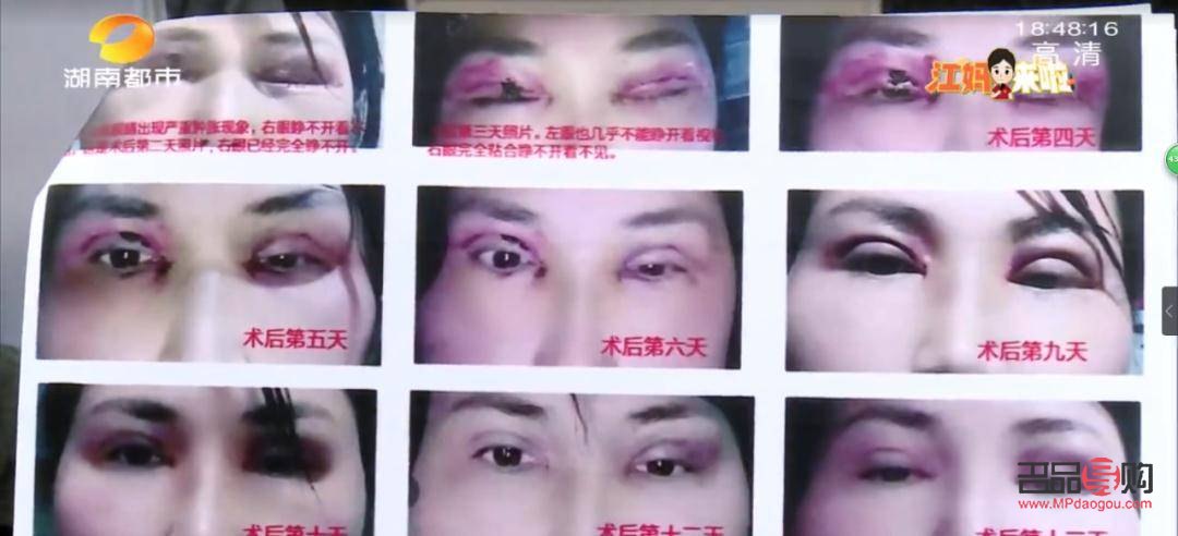 <h3>目前割雙眼皮手術(shù)費(fèi)用知多少？</h3>