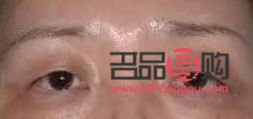 大小眼一只眼睛肌無力(大小眼一只眼睛肌無力怎么治療)