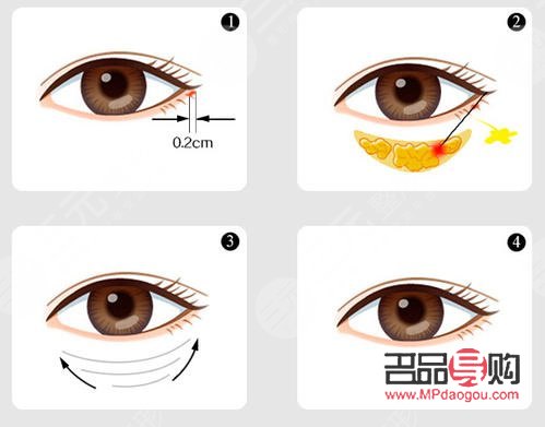 <h3>去眼袋手術(shù)前后注意事項全解析</h3>