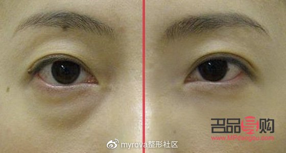 去眼袋手術前后注意事項全解析