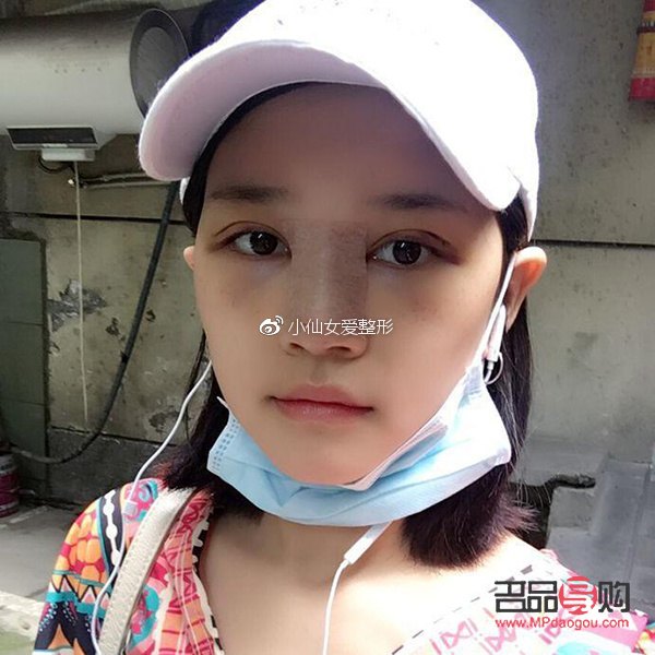 探尋雙眼皮手術之路：哪種方式恢復迅速又自然？