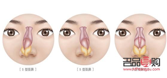 凸眼球矯正手術多少錢(凸眼球矯正手術多少錢)