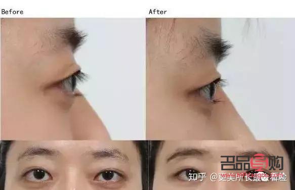 凸眼球矯正手術多少錢(凸眼球矯正手術多少錢)