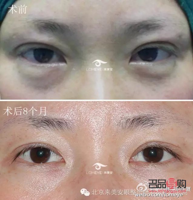 <h3>雙眼皮眼形分類大全，你屬于哪一種？</h3>