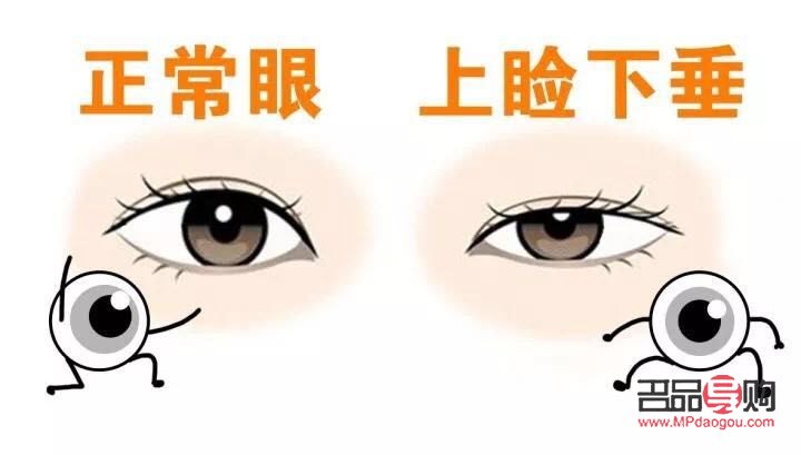 近視與上眼皮耷拉下來的關聯及應對措施