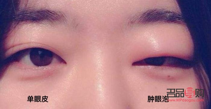 <h3>消除腫眼泡的有效非手術方法</h3>
