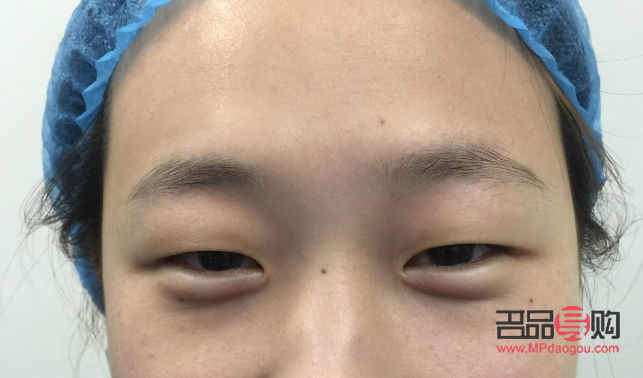 消除腫眼泡的有效非手術方法