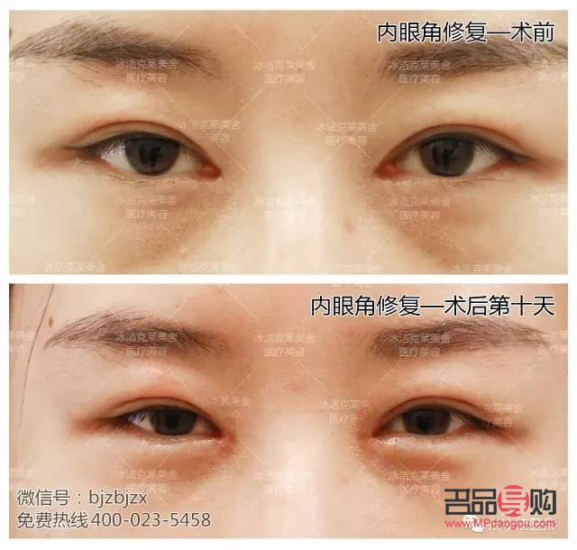 眼角開的有點大了之后還能修復嗎(眼角開的有點大了之后還能修復嗎圖片)