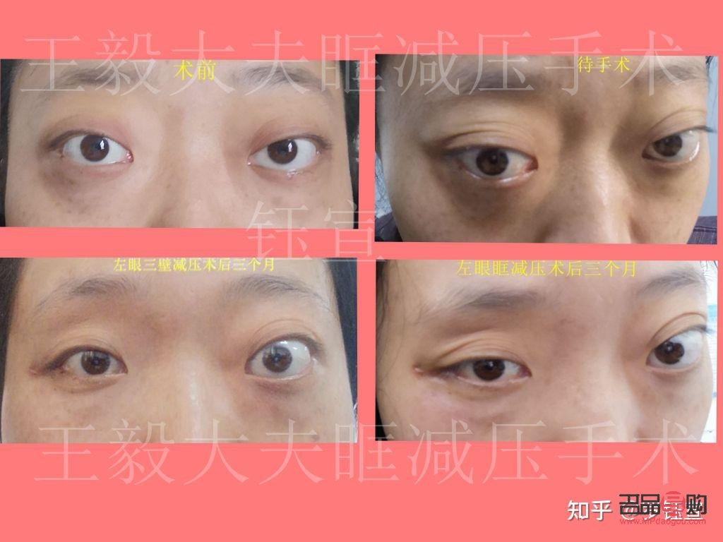 甲亢眼突日常恢復技巧(眼眶減壓手術多少錢)