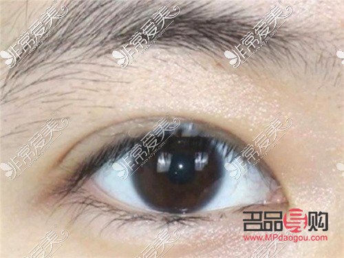 探索8毫米開扇雙眼皮的魅力