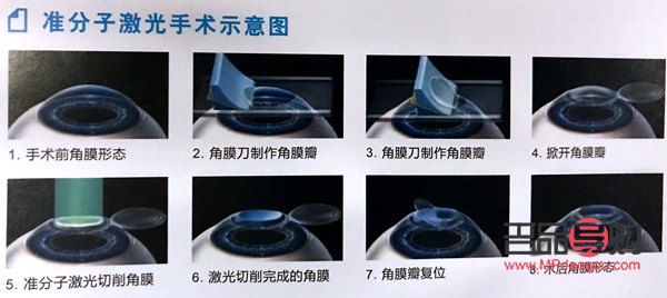近視眼矯正手術(近視眼矯正手術大概多少錢)