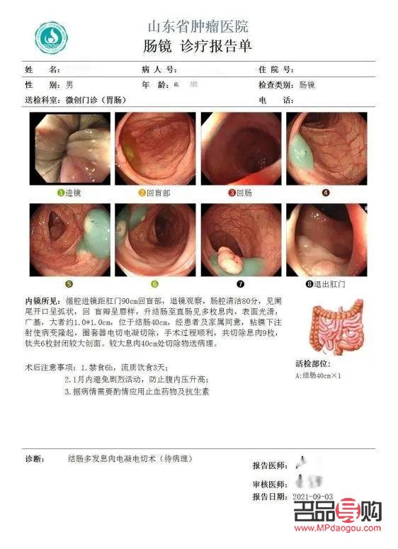 美容院割息肉疼嗎——專業解讀疼痛感受與緩解方法