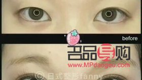 埋線雙眼皮會留疤嗎？詳細解析與注意事項