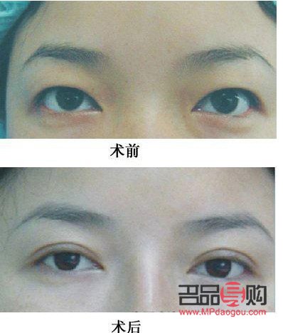 探究大小眼手術，重塑美麗雙眼