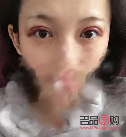 雙眼皮一個月和三個月恢復效果全解析