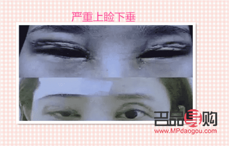 盧玲醫生雙眼皮案例分享：打造自然雙眼皮的匠心之作