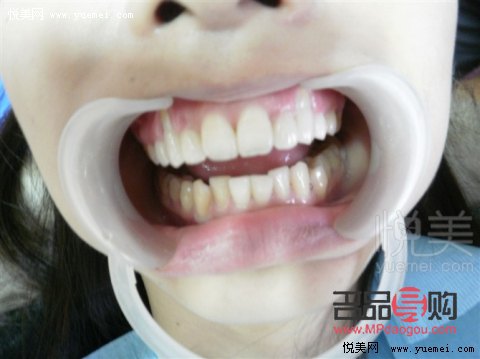 美容冠到底怎么樣——揭秘美容冠的真實效果與注意事項